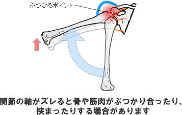 関節の軸がズレると骨や筋肉がぶつかり合ったり、挟まったりする場合があります